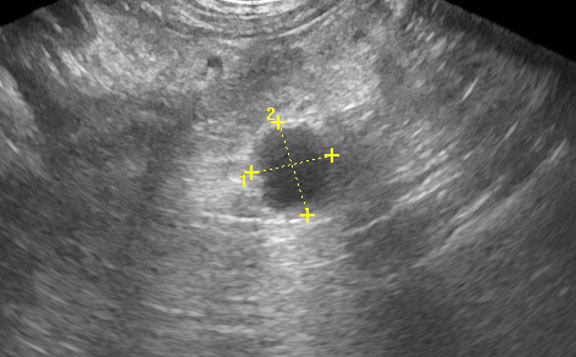 Ultrasound showing lymph node
